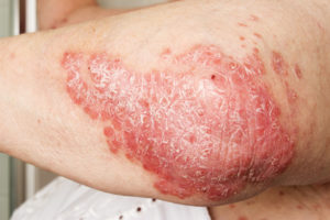 Psoriasis mit Chaga kurieren