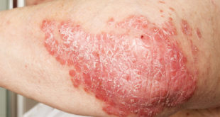 Psoriasis mit Chaga kurieren