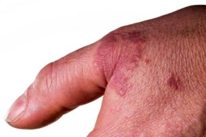 Knötchenflechte auf einer Hand 