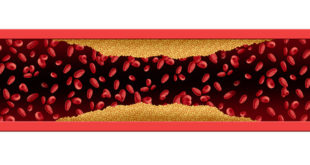 Arterie die sich verengt Darstellung Schaufensterkankheit