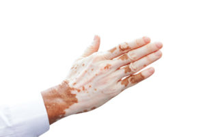 Vitiligo an einer Männer Hand