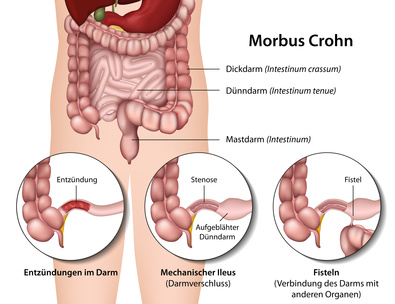 Morbus Crohn Symptome Morbus Crohn heilen