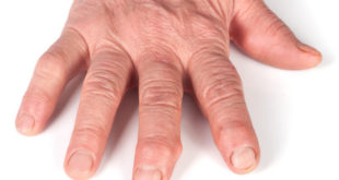Gicht Hand auf weissem Hintergrund