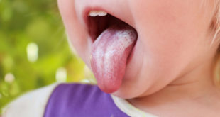 Zungenpilz bei einem Kind das die Zunge raustreckt