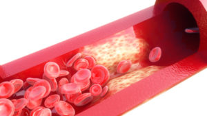 Arterienverkalkung Graphik der Arterie auf weissem Hintergrund