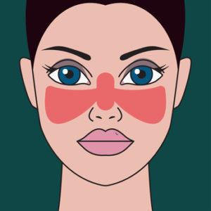 Lupus Krankheit. Frau mit roter Stelle auf ihrem Gesicht in Form des Schmetterlinges.