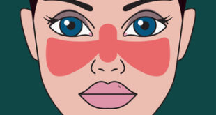 Lupus Krankheit. Frau mit roter Stelle auf ihrem Gesicht in Form des Schmetterlinges.