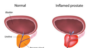 Prostatitis