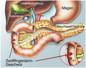 Zwölffingerdarmgeschwür 